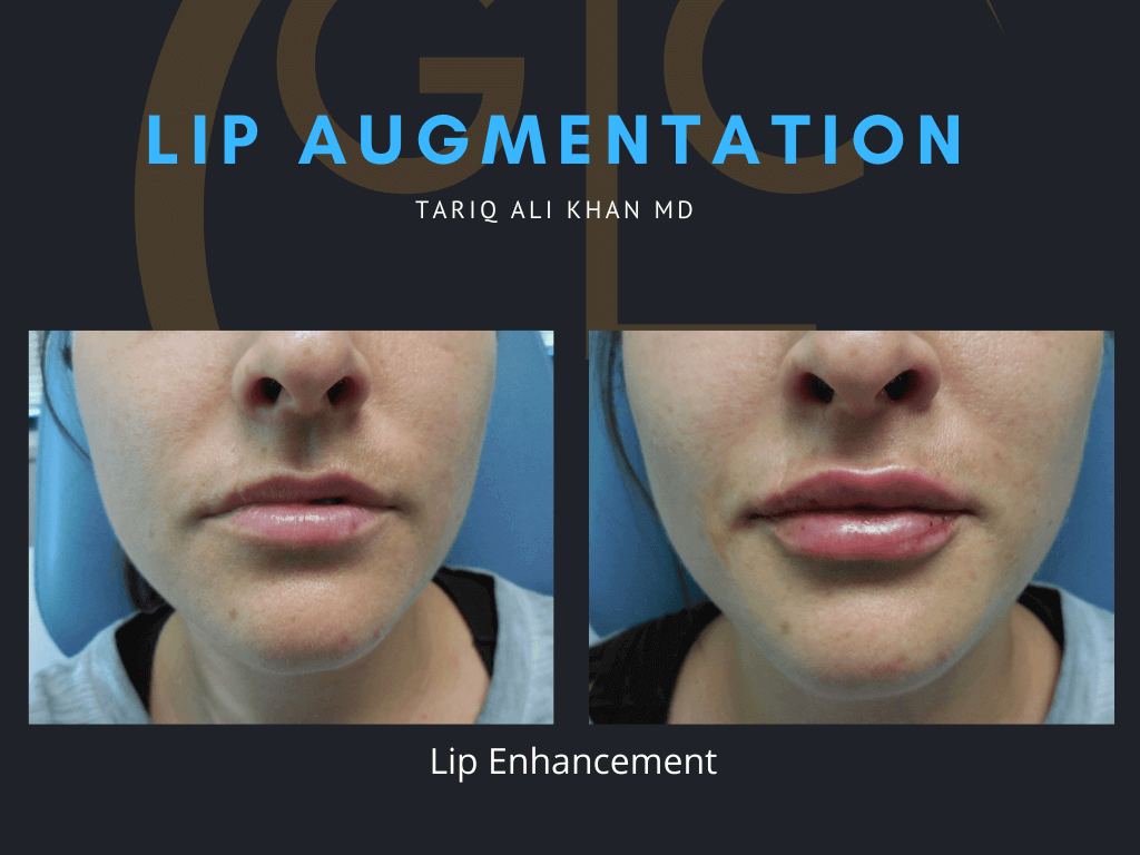 Gentle Care Laser Tustin Before and After picture - Lip Augmentation